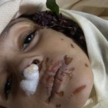 صنعاء في جربمة بشعة .. وفاة طفلة على يد زوجة أبيها بعد تعرضها لأقسى أنواع التعذيب -صور