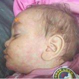 تفشي الحصبة يهدد أطفال مسيمير لحج.. والأهالي يطلقون نداء استغاثة صحي