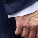 تساؤلات وراء الكدمات المتكررة بيد ترامب