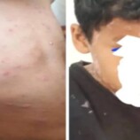 الحديدة .. تزايد حالات الإصابة بفيروس الجدري المائي
