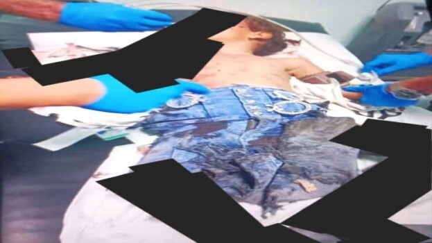 الضالع: إصابة طفلة بانفجار بقايا مقذوف متفجر أثناء توجهها إلى المدرسة